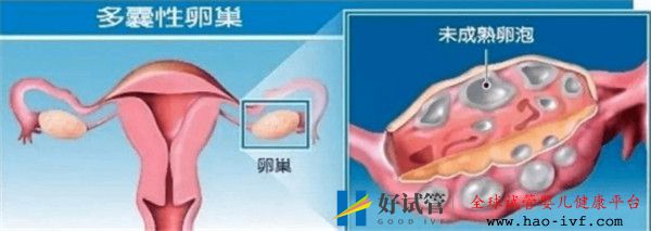 多囊卵巢綜合征對試管嬰兒成功率有哪些影響如何及時調理(圖1)