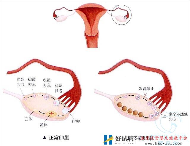 多囊卵巢綜合癥能做試管嬰兒嗎？成功率多少(圖1)