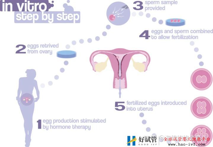 試管嬰兒1代、2代、3代、4代哪個(gè)最好真實(shí)操作過...(圖4)