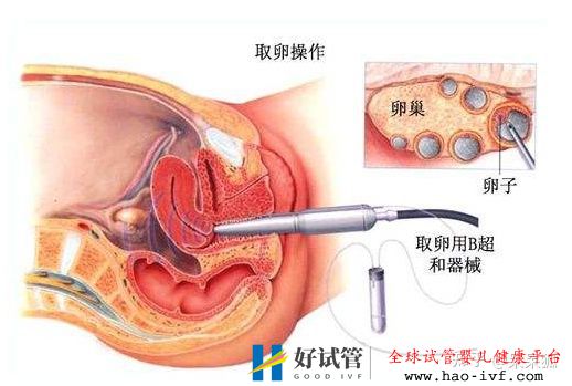 卵巢早衰做試管成功率高不高(圖2)