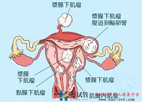 多發性子宮肌瘤可以做試管嬰兒嗎?你都了解嗎(圖1) 多發性子宮肌瘤可以做試管嬰兒嗎?你都了解嗎(圖1)