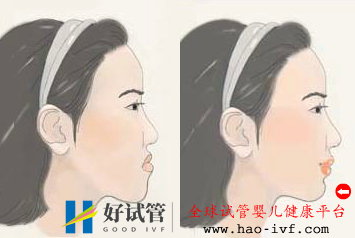 兒童地包天矯正需要多長時間(圖1) 兒童地包天矯正需要多長時間(圖1)