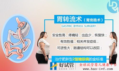 胃轉(zhuǎn)流手術(shù)要滿足什么條件才可以做?國(guó)內(nèi)有胃轉(zhuǎn)流手術(shù)嗎?(圖1) 胃轉(zhuǎn)流手術(shù)要滿足什么條件才可以做?國(guó)內(nèi)有胃轉(zhuǎn)流手術(shù)嗎?(圖1)