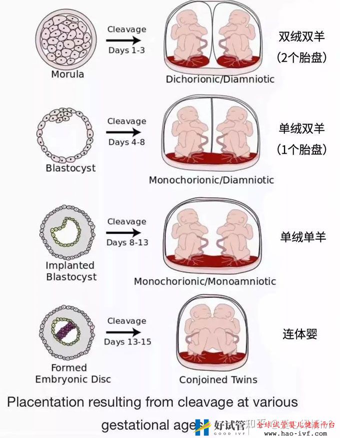 試管雙胞胎是單絨還是雙絨(圖1)