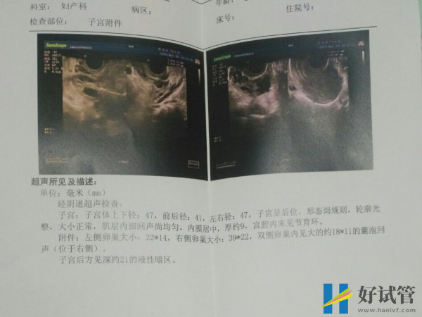 優勢卵泡太多是無需處理的