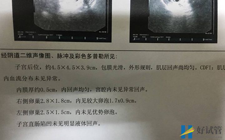 做試管前要先進行b超檢查