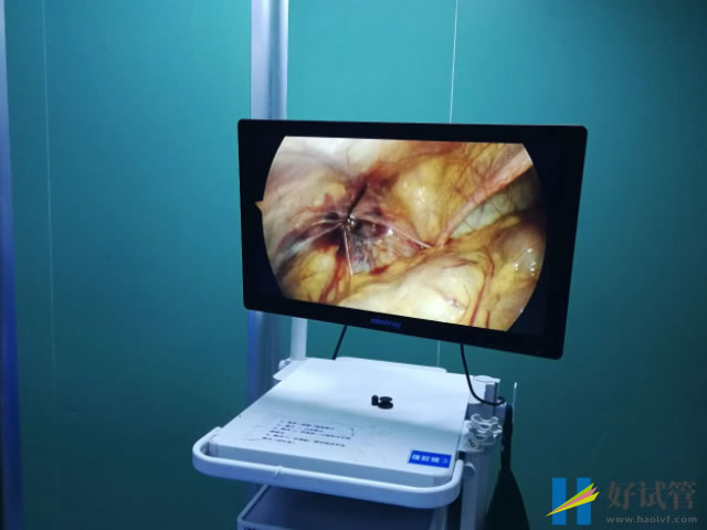 腹腔鏡手術可以治療巧囊
