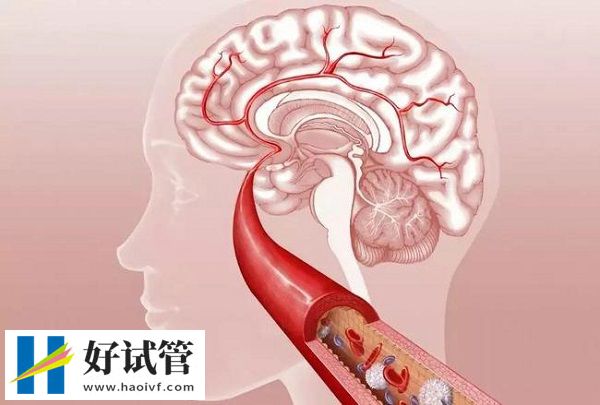 用拜阿司匹林預防心腦血管病要終身用藥