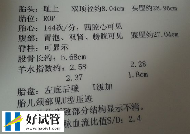 羊水過多會導致胎兒呼吸困難