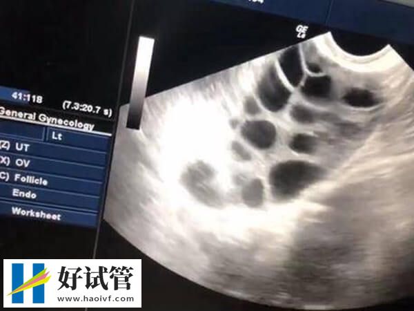 試管嬰兒前要注意什么