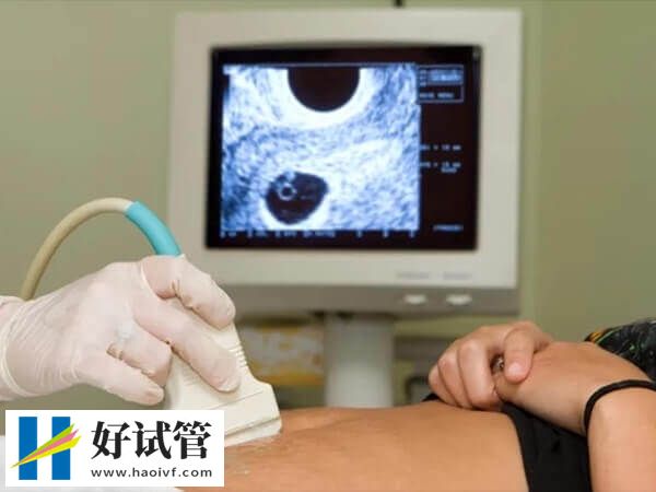 試管嬰兒需要做b超進行排卵監測
