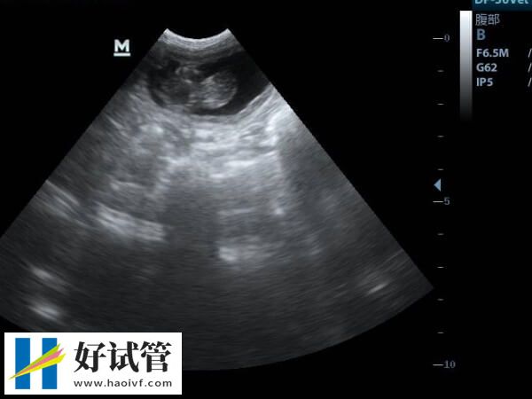 香港大學(xué)深圳醫(yī)院做試管多少錢一次