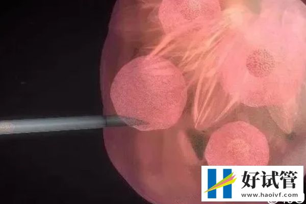 取卵后醫(yī)生會(huì)發(fā)告知患者