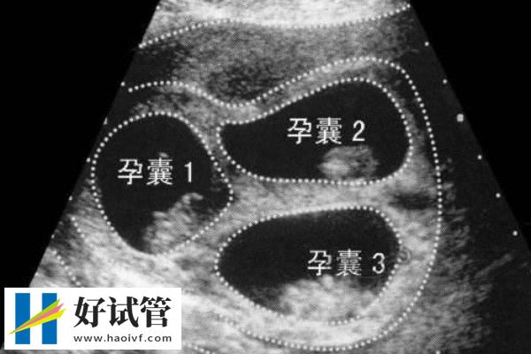 胚胎移植是將胚胎放在宮腔中