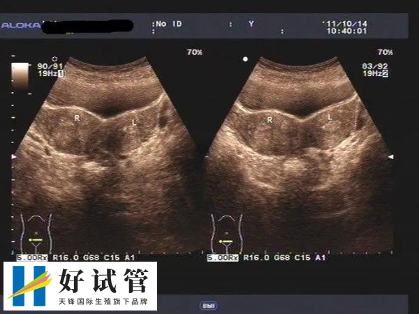 荊州中心醫院試管不一定生雙胞胎