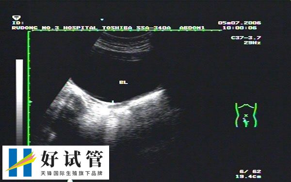 超聲檢查可以確定受精卵的發育情況和大小