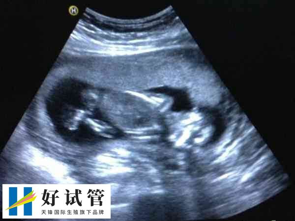 不做宮腔鏡不影響移植