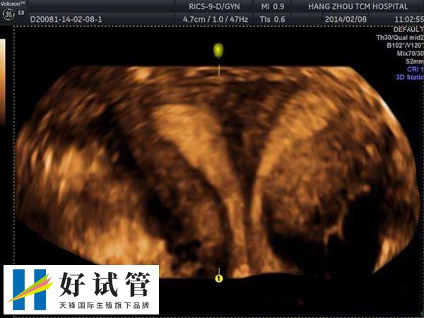 單胚胎移植可顯著降低多胎妊娠風險
