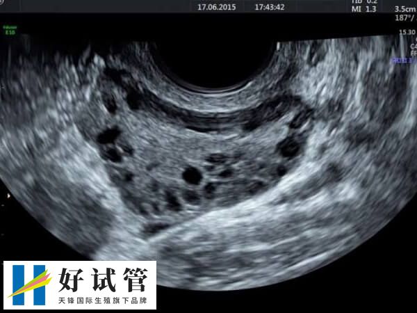 多囊卵巢是一種常見(jiàn)的內(nèi)分泌失調(diào)疾病