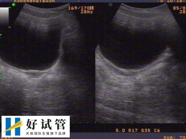 縱隔子宮可以通過治療輔助懷孕