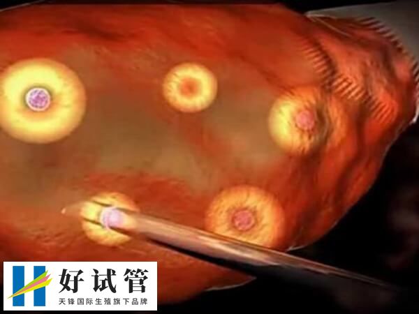 試管取21個(gè)左右的卵子是比較理想的