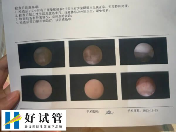宮腔鏡檢查是一種現代醫學手段