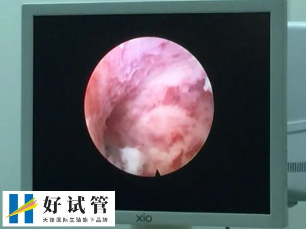 宮腔鏡檢查是一種重要的婦科檢查方法