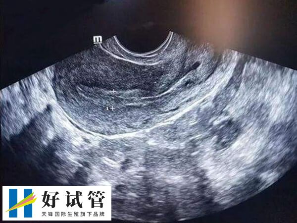 宮頸息肉通常是由緩慢炎癥引起的